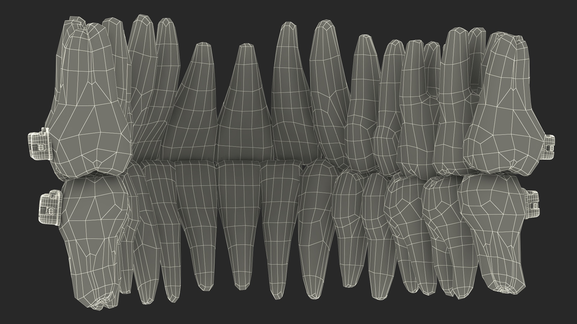 Ligature-Free Braces on Plastic Teeth 3D