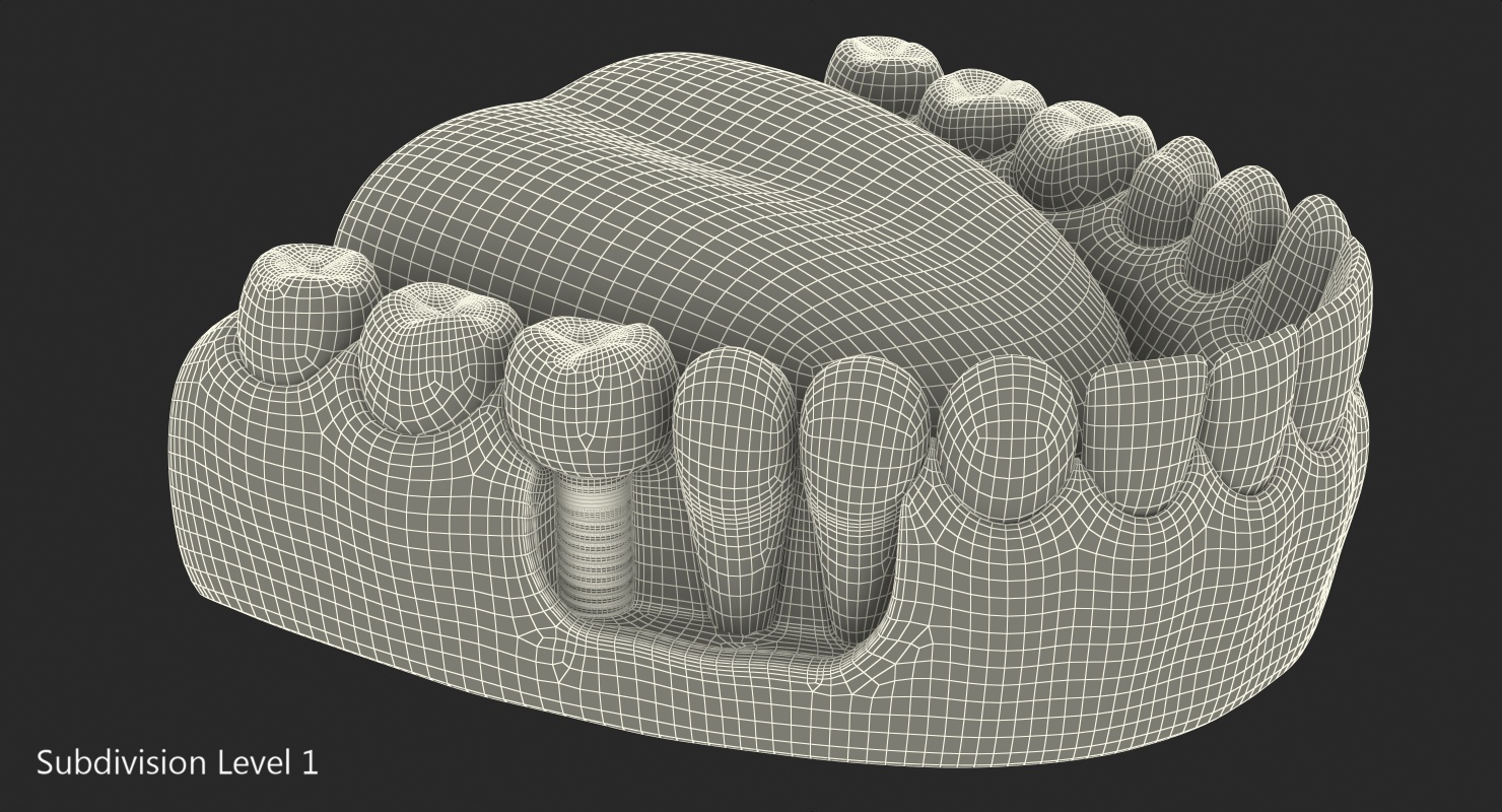 3D Teeth Tongue Medical Model With Dental Implant